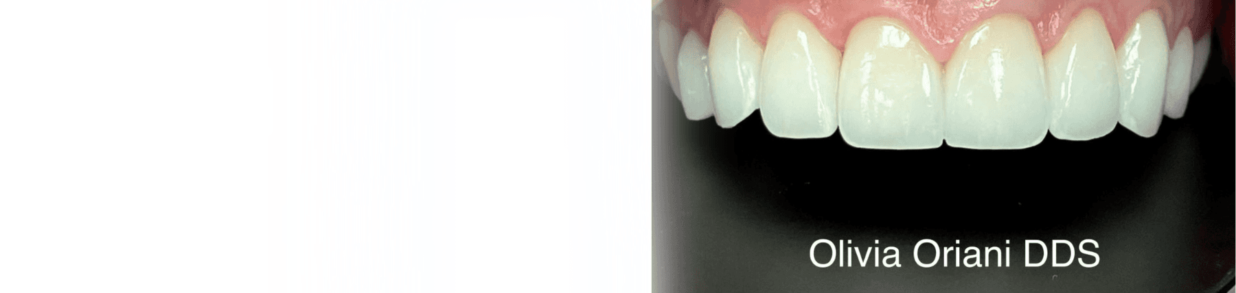 Porcelain Veneers | Dentist