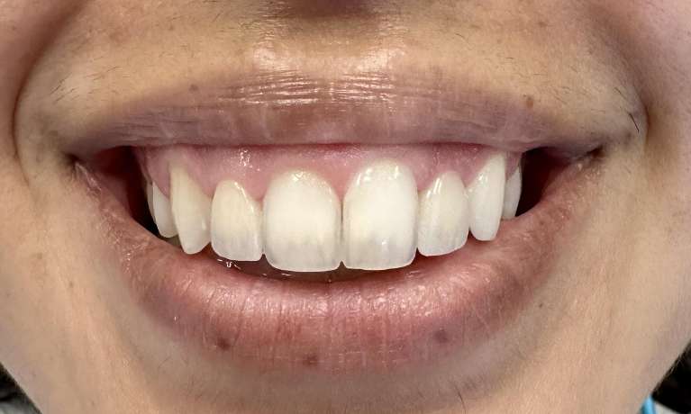 Case-After-Image