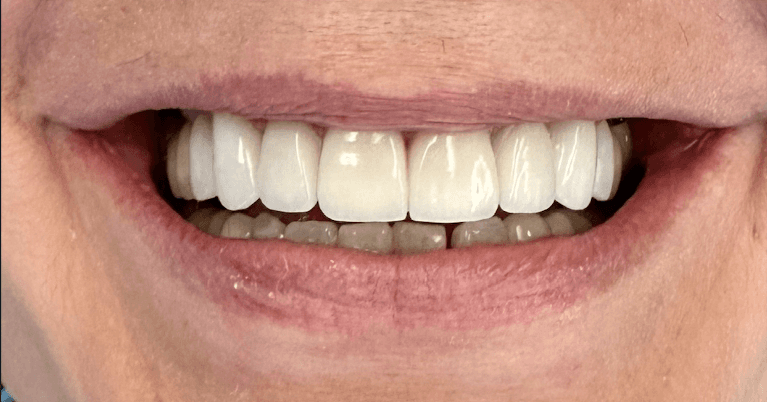 Case-After-Image