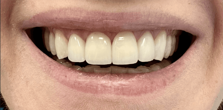 Case-After-Image