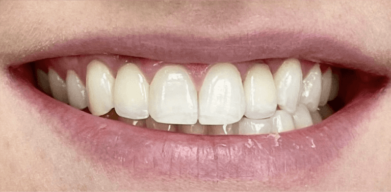 Case-After-Image