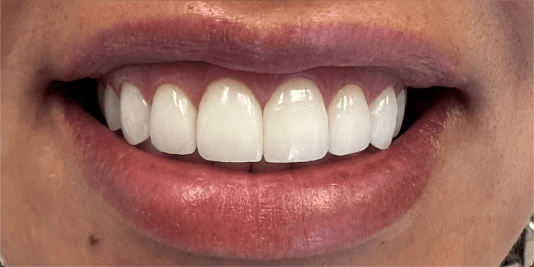 Case-After-Image