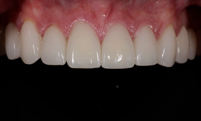 After treatment - Case