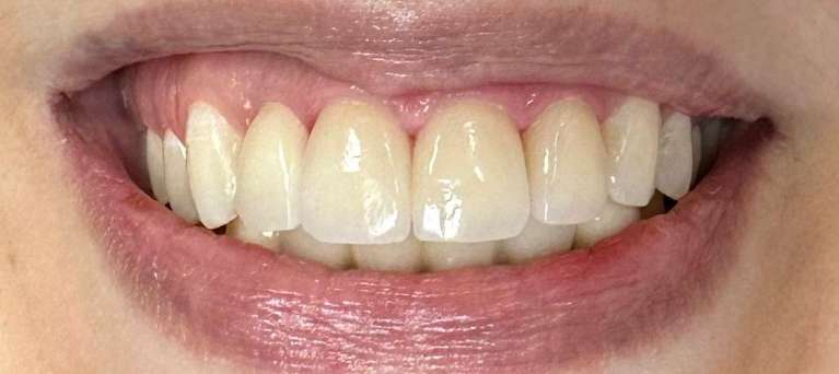 Case-After-Image