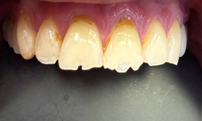 Before treatment - Case